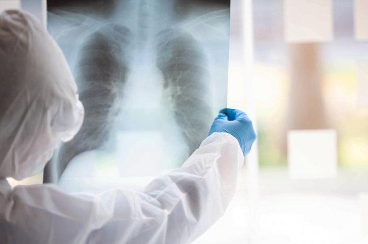 239 науқас пневмониядан сауығып шықты